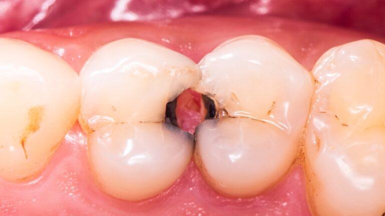 carie denti